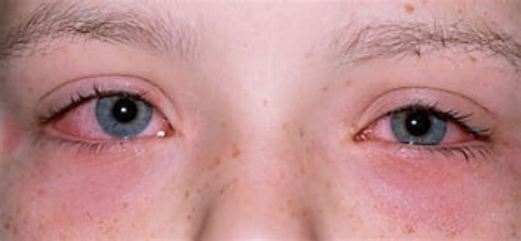 Kliande ögon allergi